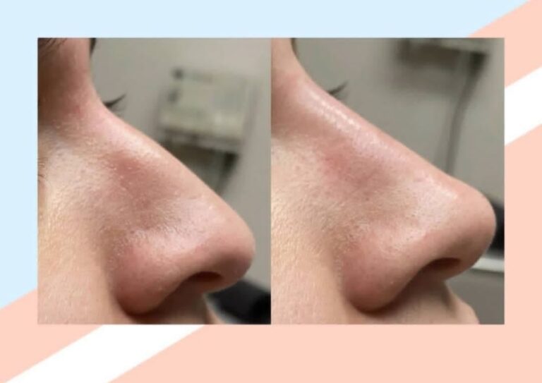 Correcting the shape of the nose with gel injection
