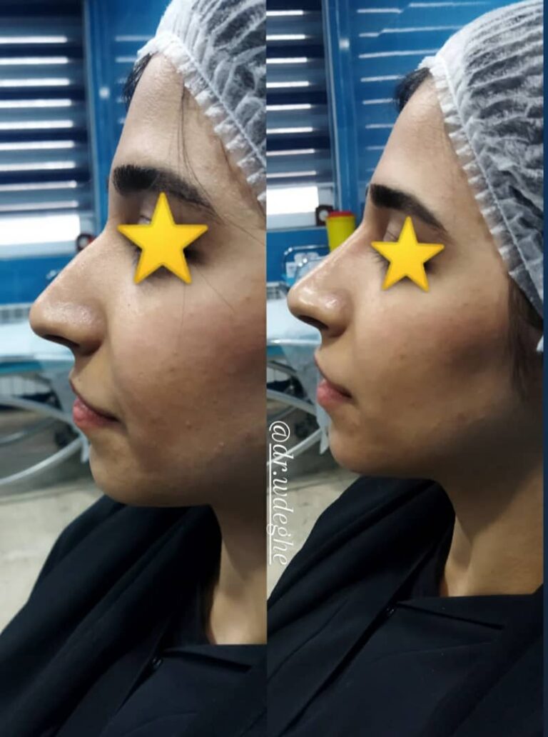Correcting the shape of the nose with gel