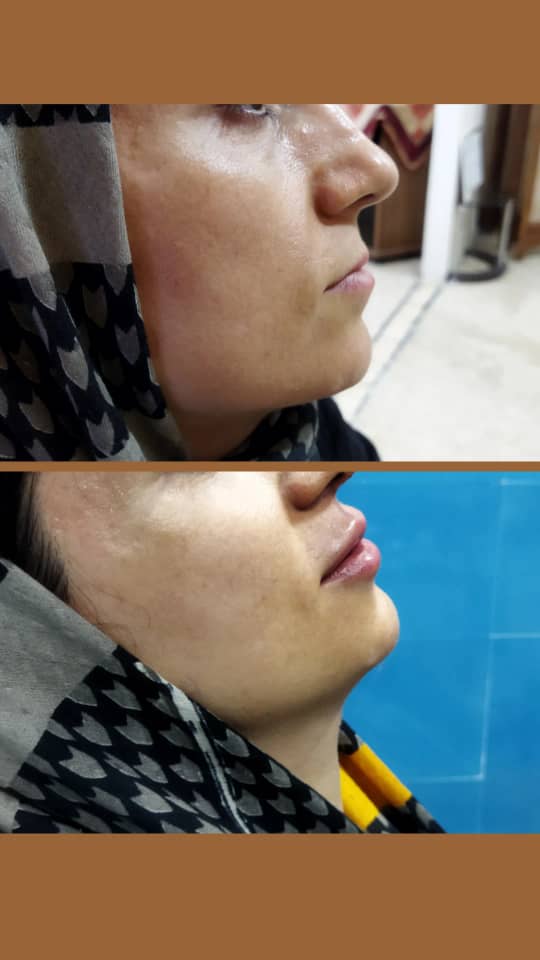 Gel injection for lips, chin and angle of the jaw